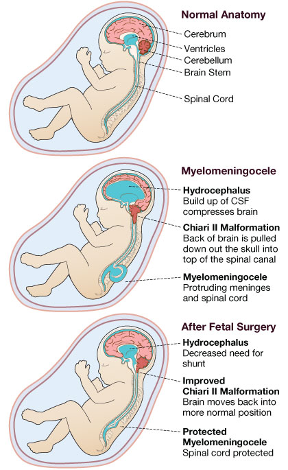 SPINA BIFIDA ANOATOMIA