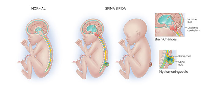 SPINA BIFIDA SINTOMI