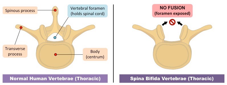 SPINA BIFIDA COS È